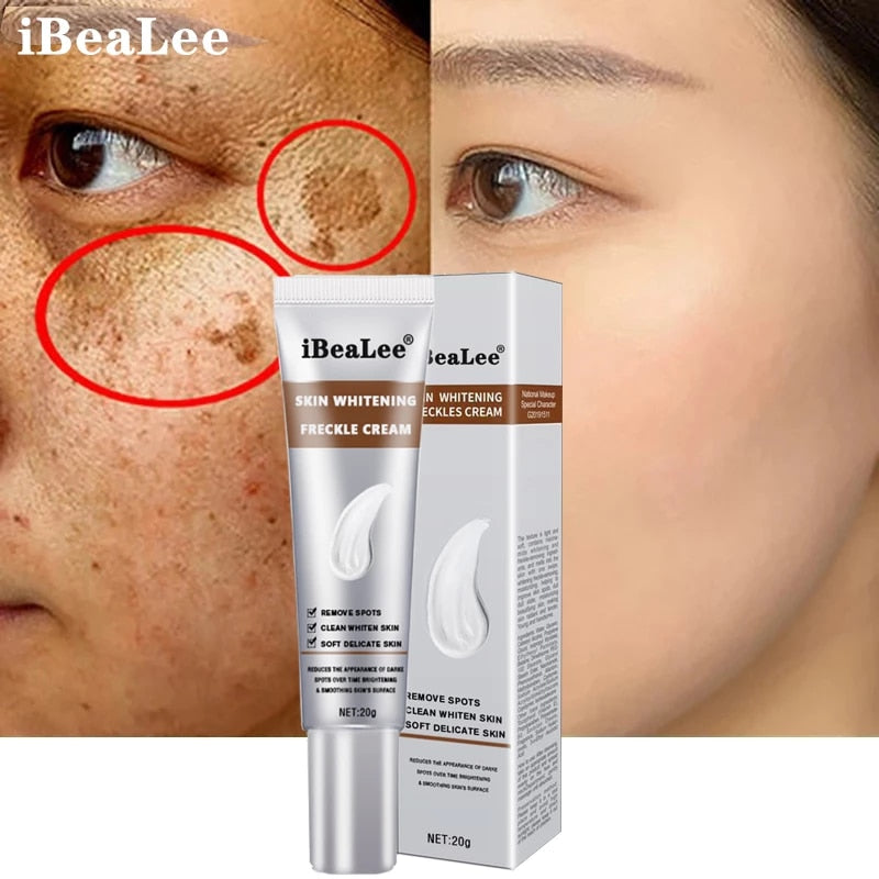 iBeaLee Whitening Freckle Cream Remove Melasma Cream Remove Dark Spots Melanin Melasma Remover Brighten Skin Anti-Aging